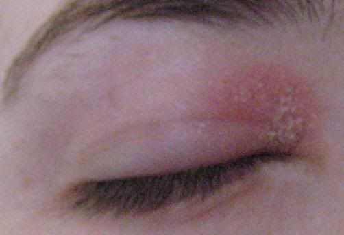 What causes dry patches on eyelids - Answers on HealthTap