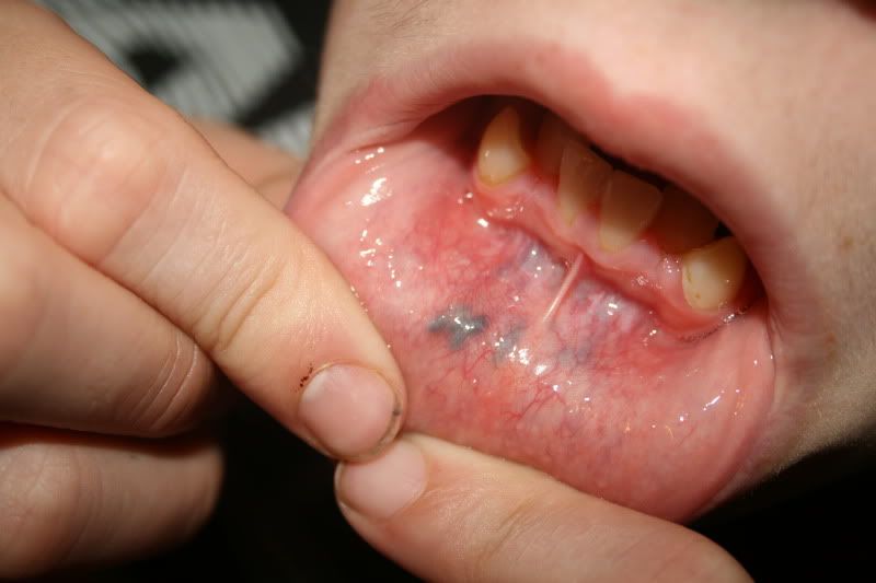 Black Lump In Mouth 71